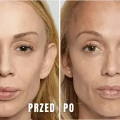 Jak długo wchłania się kwas hialuronowy i co wpływa na efekty?