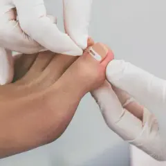 Tamponada paznokcia - skuteczna metoda na wrastające paznokcie