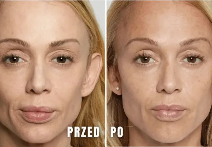 Jak długo wchłania się kwas hialuronowy i co wpływa na efekty?