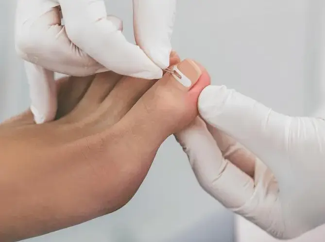Tamponada paznokcia - skuteczna metoda na wrastające paznokcie