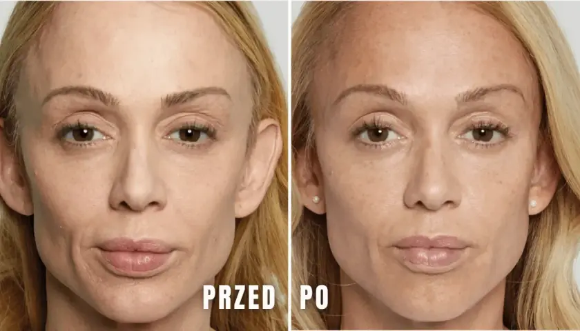 Jak długo wchłania się kwas hialuronowy i co wpływa na efekty?