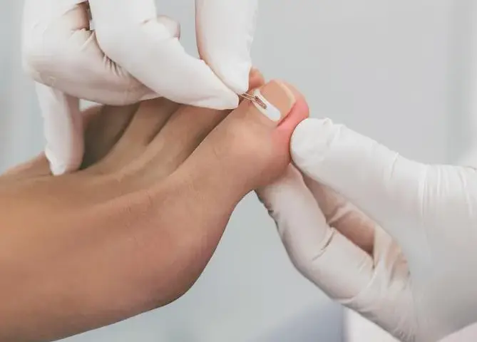 Tamponada paznokcia - skuteczna metoda na wrastające paznokcie