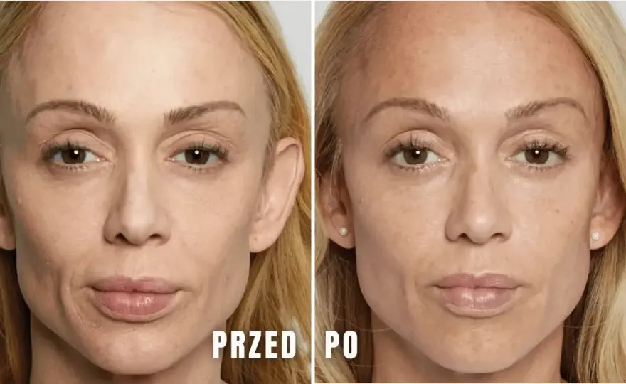 Jak długo wchłania się kwas hialuronowy i co wpływa na efekty?